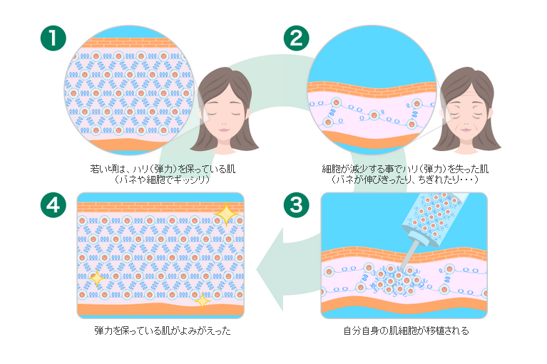 肌の再生治療の仕組み